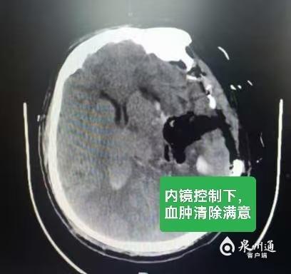 泉州市第一医院“医疗援宁”结硕果 助力当地医院成功掌握神经外科四级手术(图2)