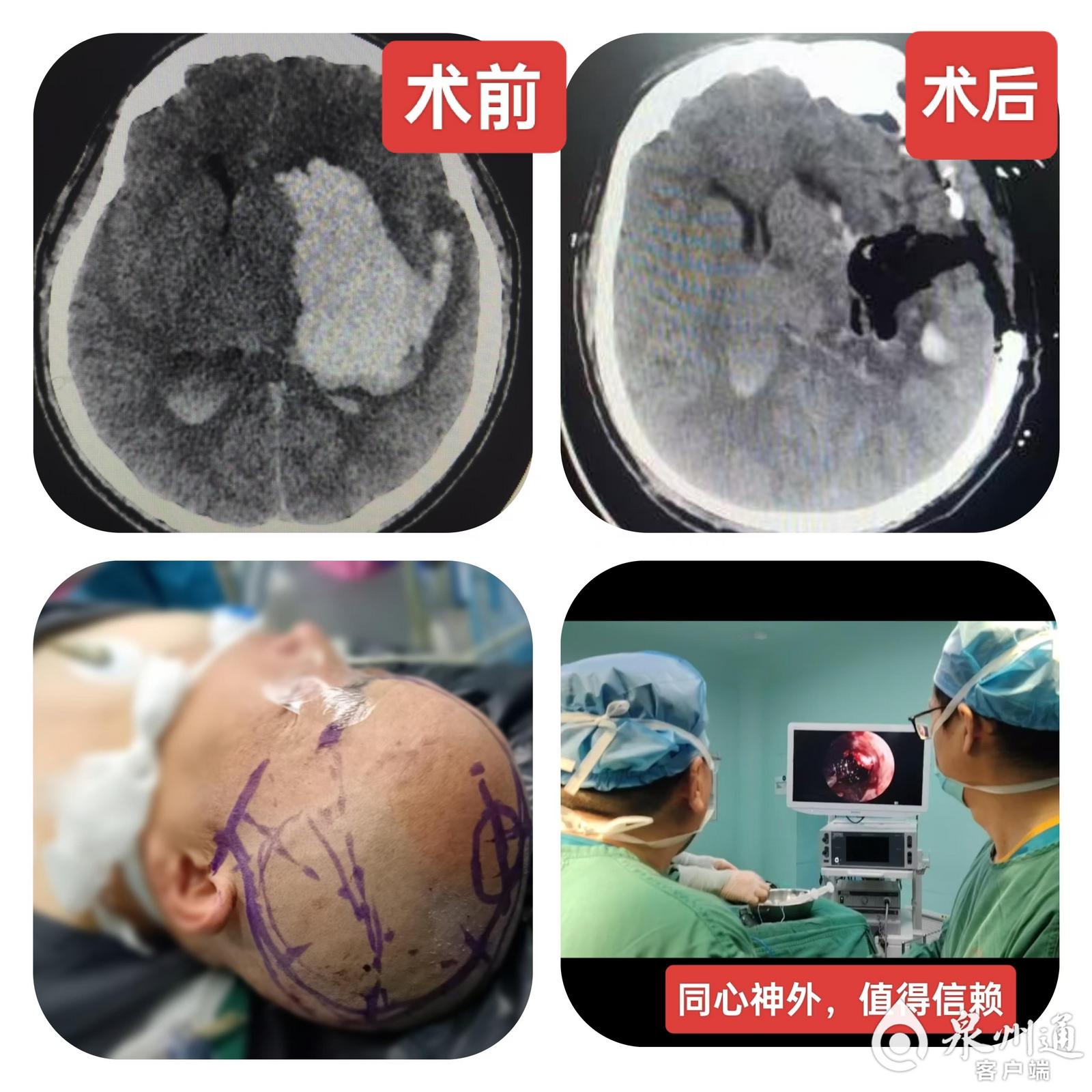 泉州市第一医院“医疗援宁”结硕果 助力当地医院成功掌握神经外科四级手术(图1)