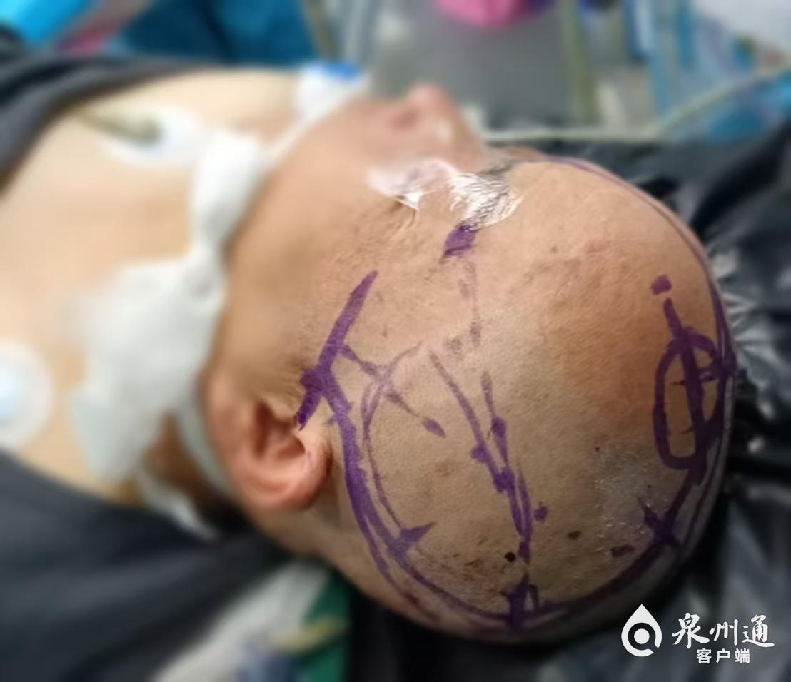泉州市第一医院“医疗援宁”结硕果 助力当地医院成功掌握神经外科四级手术(图4)