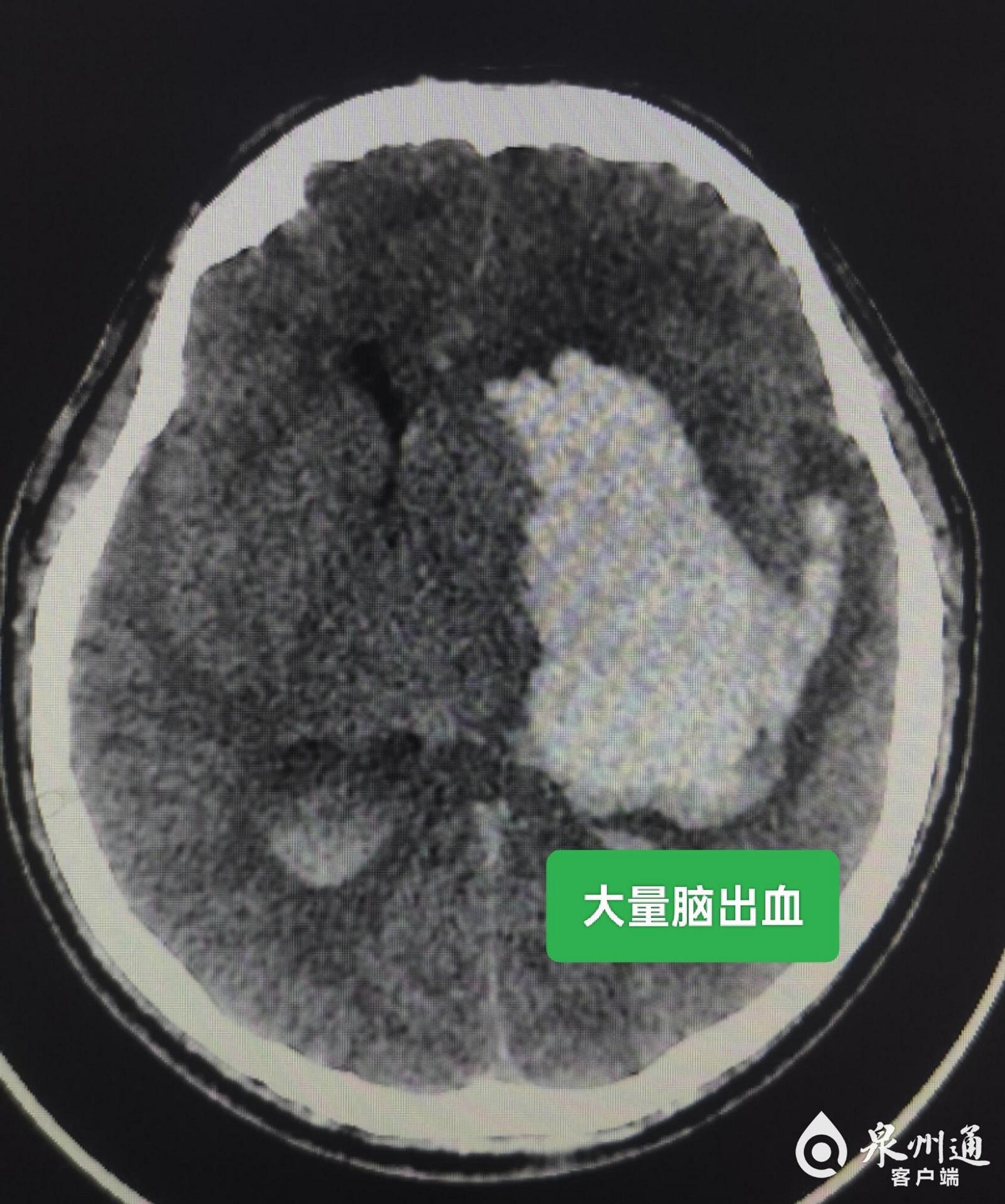 泉州市第一医院“医疗援宁”结硕果 助力当地医院成功掌握神经外科四级手术(图3)
