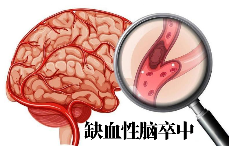 【健康科普】关于脑卒中你知道多少？(图1)