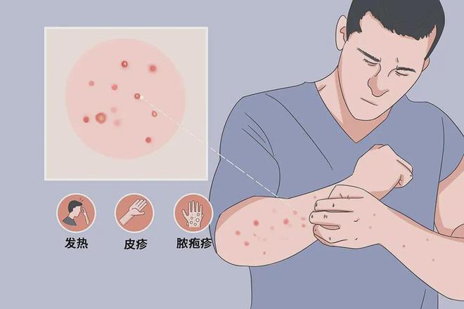 4人亲密接触后感染！中疾控发现一起聚集性疫情(图3)