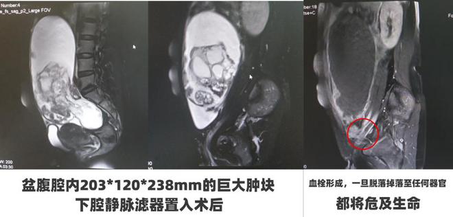 妙手仁心呵护女性健康！草莓医院妇科2024年攻克两大疑难手术(图1)