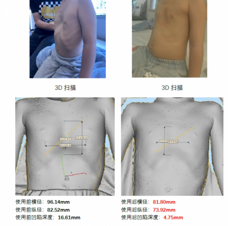十载匠心铸就易康医疗发布漏斗胸鸡胸智能矫形系统(图2)